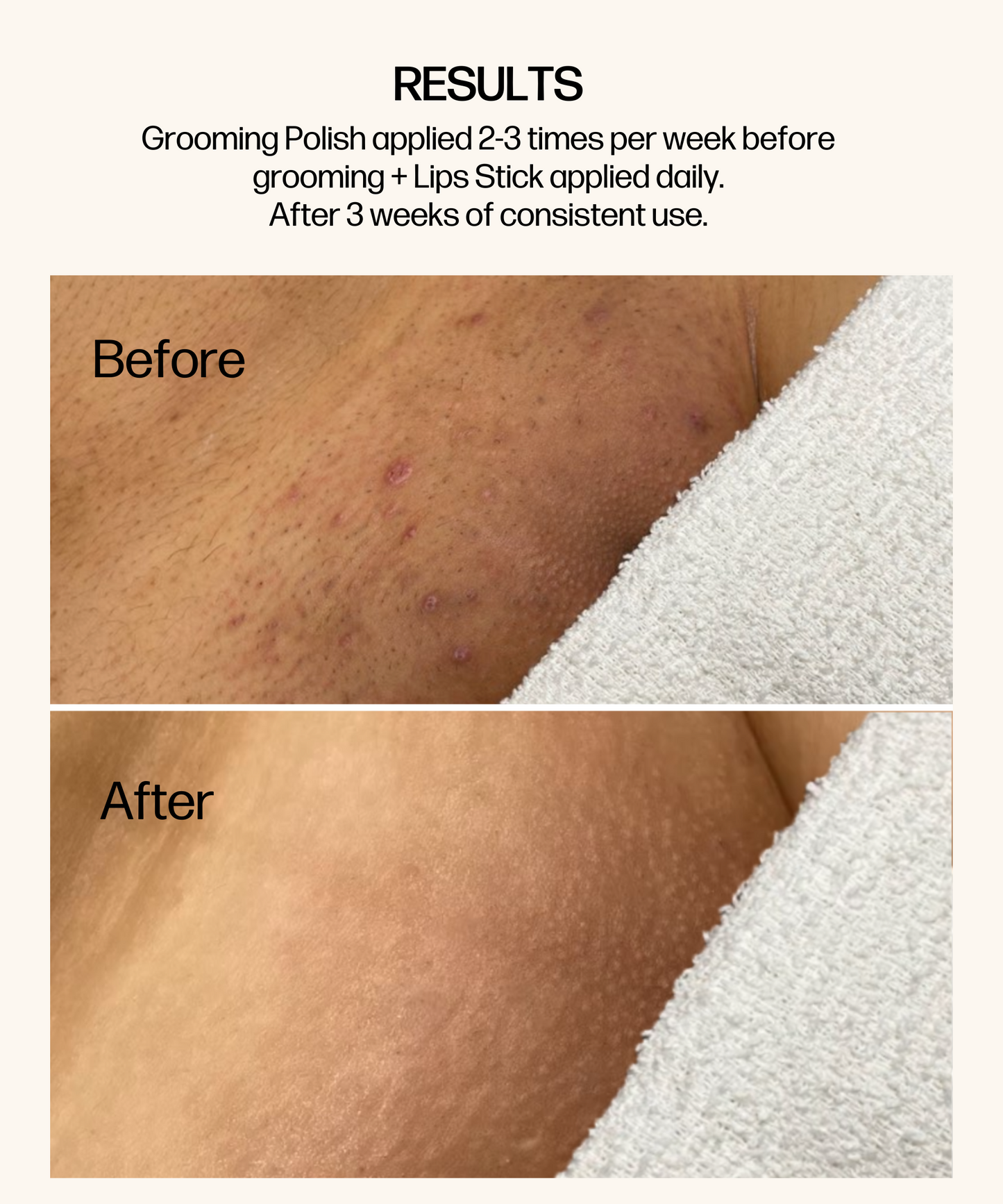 VMAGIC® Ingrown Prevention Duo